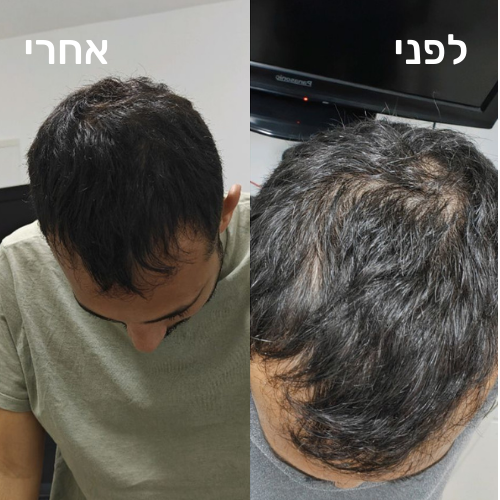 HairBoost - רולר לצמיחת שיער הראש